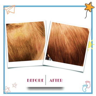 Baby Comb and Brush for Cradle Cap - Gummia